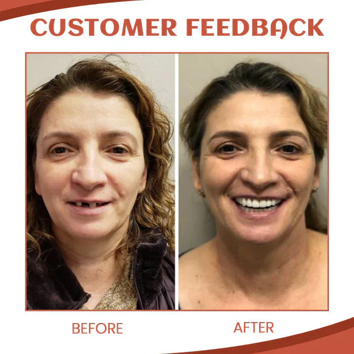 Silicone Denture Set ~ Achieve a natural, confident smile instantly - Image 6